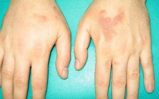 El dolor en las articulaciones de las manos puede ser síntoma de parásitos.