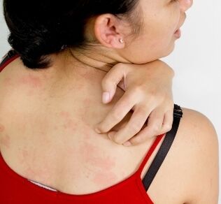 Granulomas en el cuerpo síntomas de presencia de parásitos.