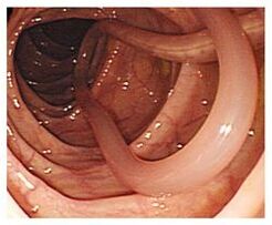 Parásitos en el cuerpo humano.