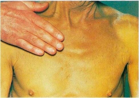 Ictericia por parásitos en el cuerpo.